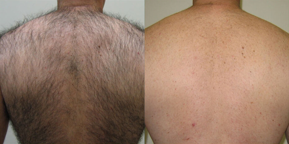 Laser hair removal example