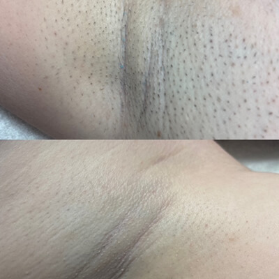 Laser hair removal example