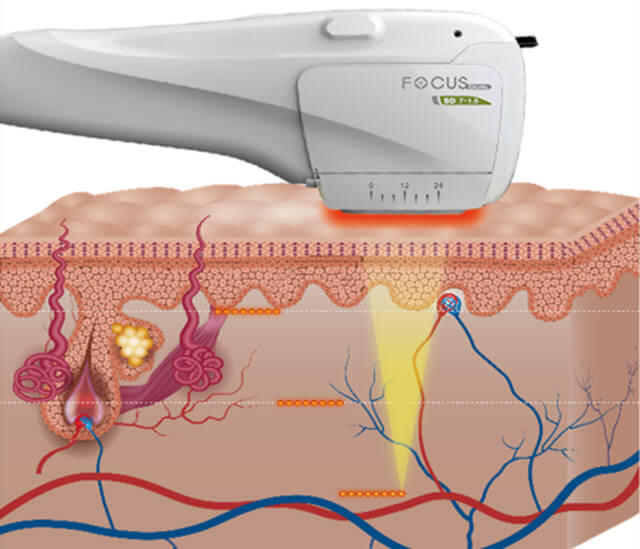 High Intensity Focused Ultrasound example