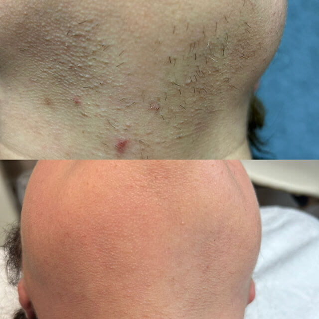 Laser hair removal example