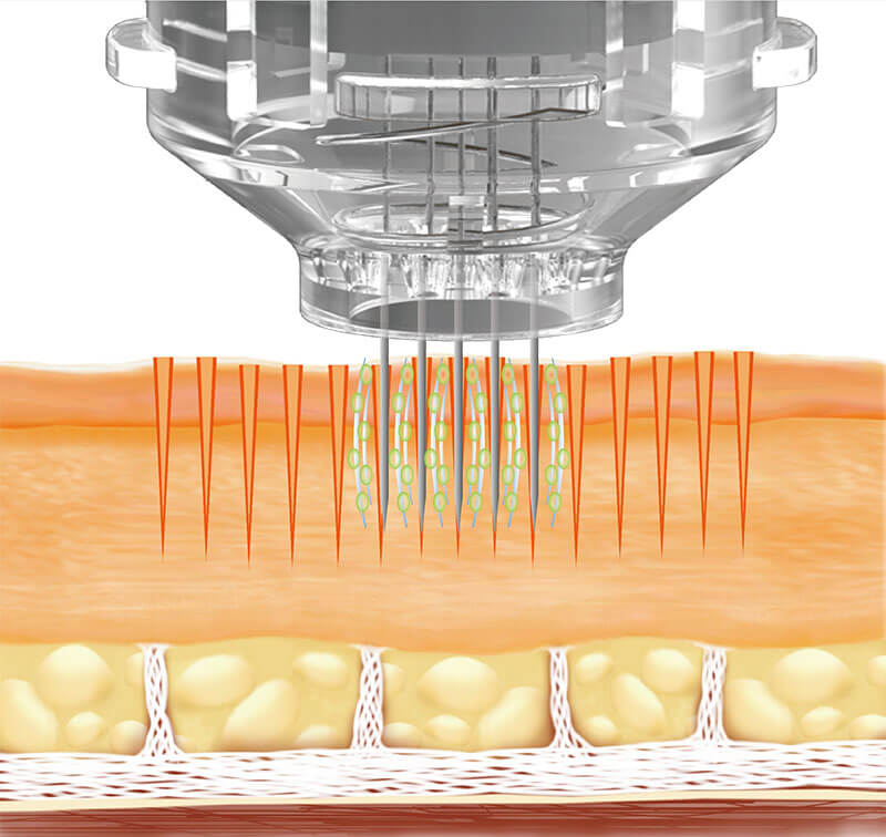 Radio Frequency Microneedling example