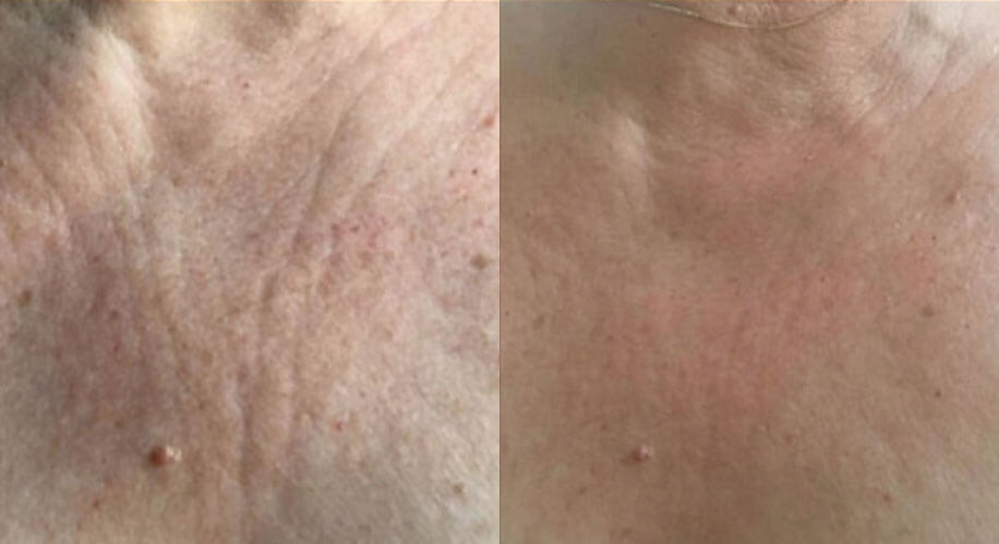 Radio Frequency Microneedling example