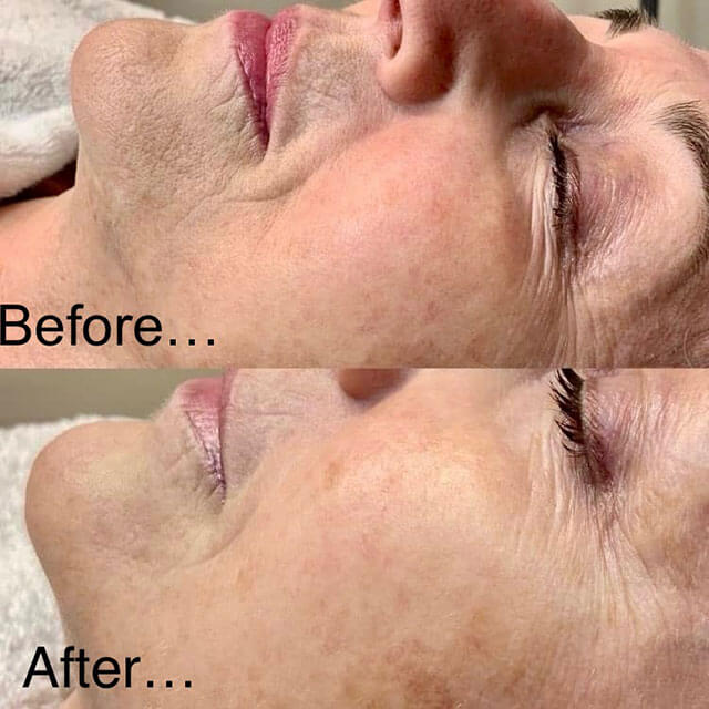 Radio Frequency Microneedling example