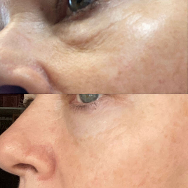 Radio Frequency Microneedling example