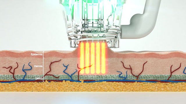 Radio Frequency Microneedling example