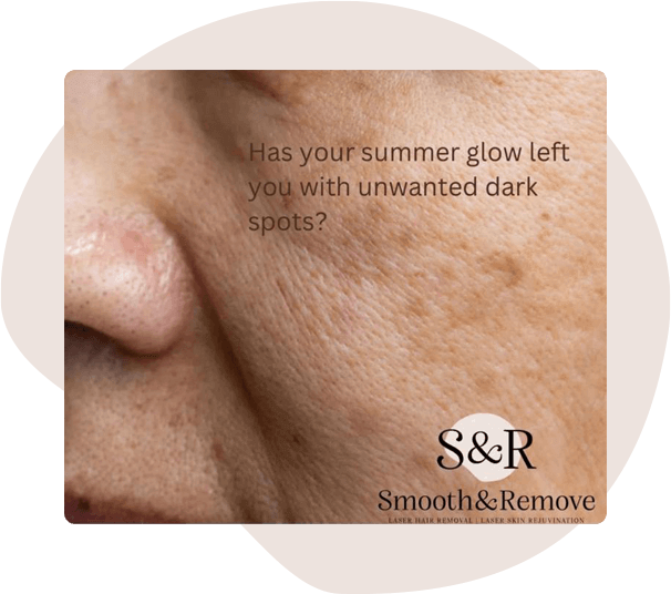 Pigmentation/sun damage laser treatment