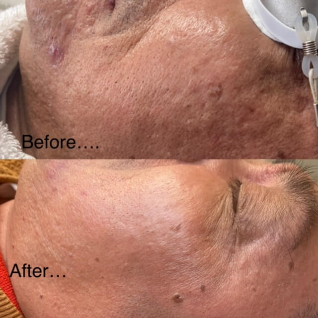 Laser skin rejuvenation/Laser genesis example
