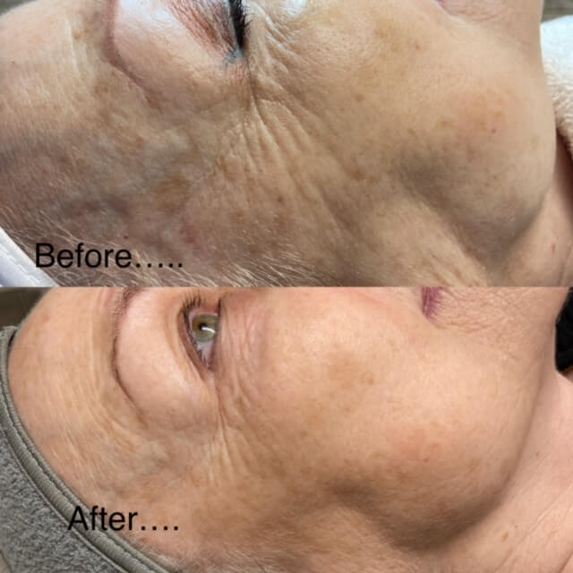 Laser skin rejuvenation/Laser genesis example